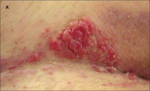 Cutaneous Metastasis of Prostatic Adenocarcinoma