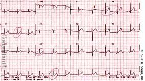 Acute Pericarditis in an 8-Year-Old Girl