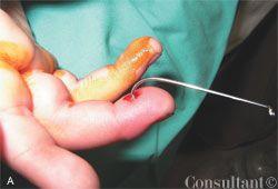 Removing Fishhook From Finger