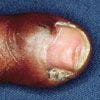 Ectopic Nail