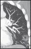 Septic Pulmonary Emboli