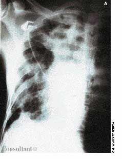 Unusual Manifestations of Sarcoidosis