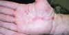 Erythema Multiforme on Hands of a 55-Year-Old Woman