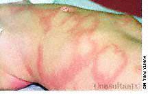 Urticaria