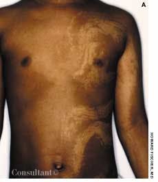 Hypomelanosis of Ito