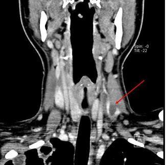 Lemierre syndrome 