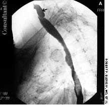 Zenker Diverticulum in an Older Woman