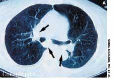 Calcification of the Mediastinum in an Asymptomatic Woman