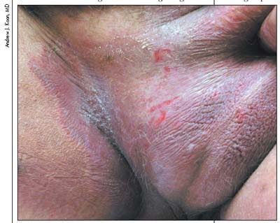 A Man With a Refractory Groin Rash