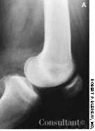 MRI Diagnosis of Bone Bruise