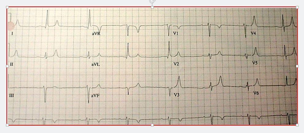 Nausea, Vomiting, and a Suspicious EKG 