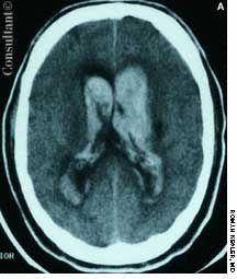 Acute Aneurysm Rupture