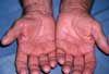 Carpal Tunnel Syndrome in a 67-Year-Old Man