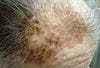 Suspect Skin Lesions-A Photo Quiz