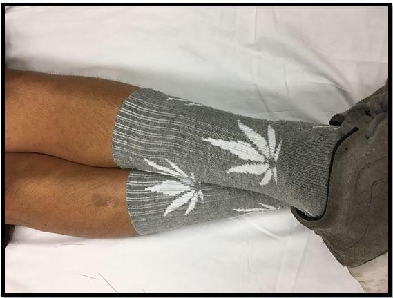 "Pot socks" sign. Brady Pregerson, MD