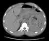 Angiomyolipoma