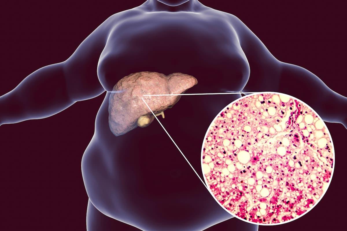 Novel “Triagonist” Retatrutide Resolved Steatosis in Over 85% of Patients with MASLD and Obesity / Image credit: ©Dr_Microbe/AdobeStock