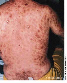 Cutaneous T-Cell Lymphoma