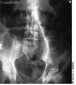 Sigmoid Colonic Volvulus