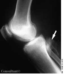 Synovial Osteochondromatosis