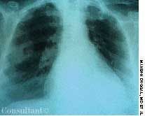 Aspiration Pneumonia