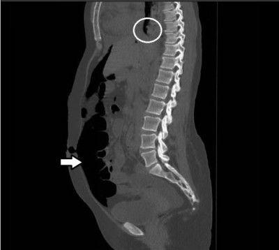 Pneumatosis Cystoides Intestinalis: What’s the Truth?