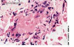 Pauci-Immune Crescentic Glomerulonephritis