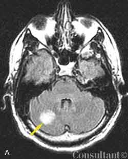 Arterial Gas Embolism