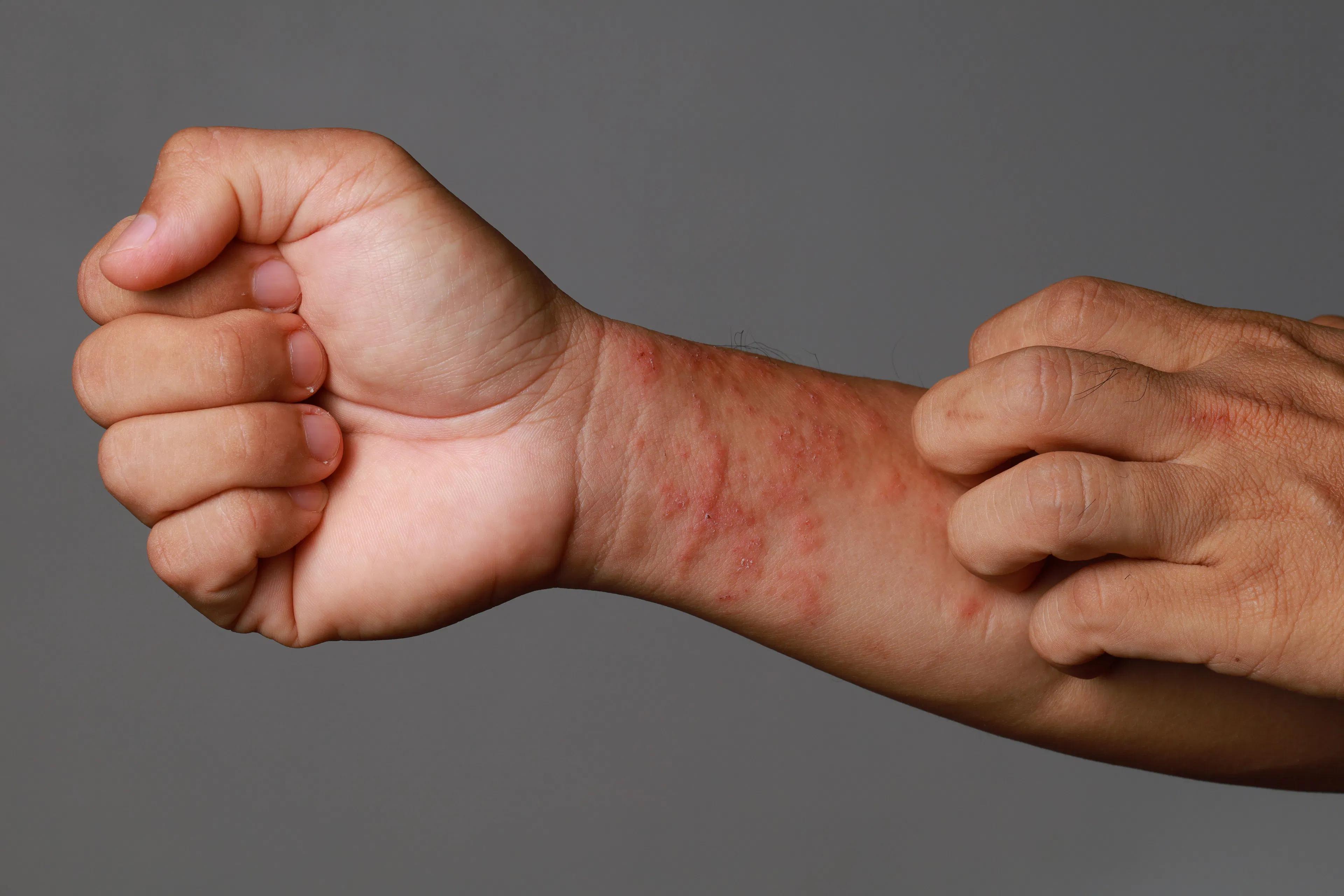 How to Define an Atopic Dermatitis Flare: Survey Seeks New Patient Consensus / image credit eczema:©Ityuan/stock.adobe.com