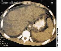 Hepatic and Splenic Infarction in Systemic Lupus Erythematosus