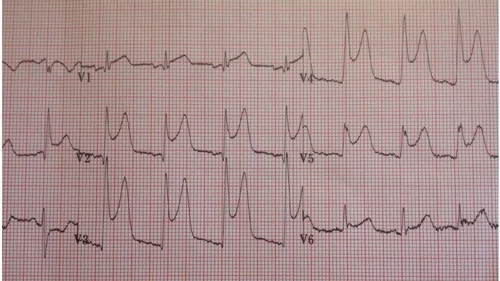 Managing acute coronary syndrome