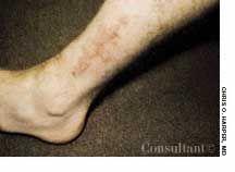 Lichen Planus: Quick Tips