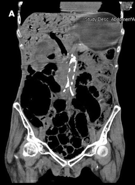 Pneumatosis Intestinalis