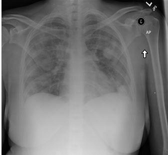 Lemierre syndrome 