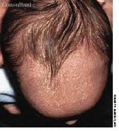 Seborrheic Dermatitis of the Scalp