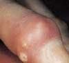 Acute Gouty Arthritis and Gouty Tophus