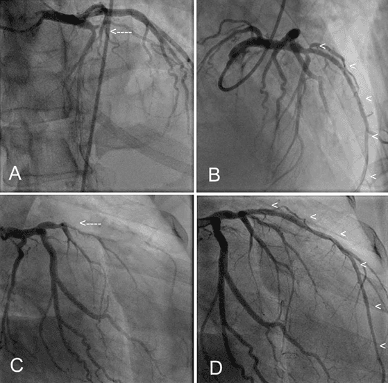 Coronary angiograms showing the left anterior descending coronary artery