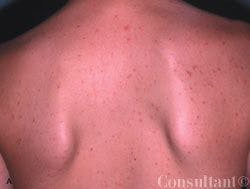 Inflamed Keratosis Pilaris