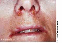 Atypical Locations of HSV Infection