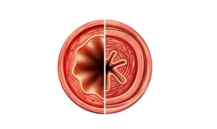 Asthma: Long-acting Muscarinic Antagonists Overused, Up Exacerbation Risk 