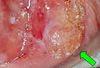 Squamous Cell Carcinoma of the Penis