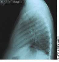 Situs Inversus Totalis Benign and Unusual