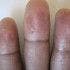 Raynaud Phenomenon as a Manifestation of Systemic Disease