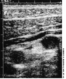 Acute Appendicitis:  Two Cases