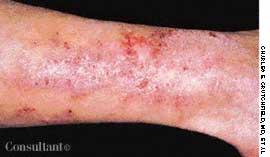 Dermatitis Herpetiformis