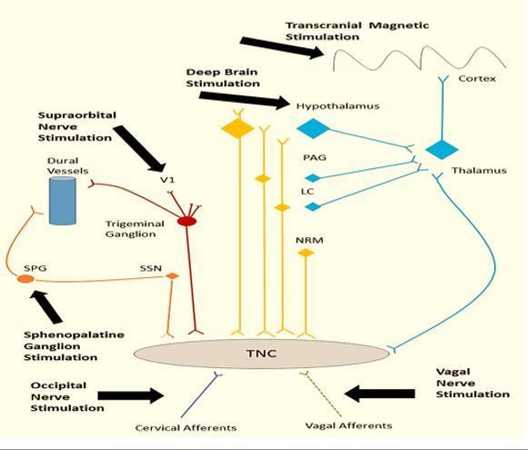 Neuromodulation, migraine, aura, headache 