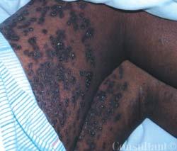 Cutaneous Calcinosis in a Child With Tertiary Hyperparathyroidism