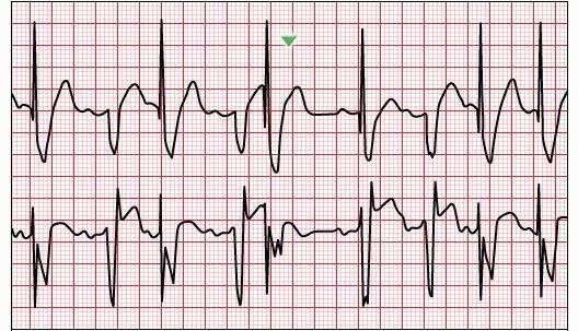 Pacemakers and AICDs: Nomenclature and Malfunction