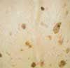 Seborrheic Keratoses in Elderly People