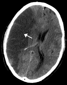 Stroke Rounds: Afib Stroke Predictor May Overestimate Risk for Some